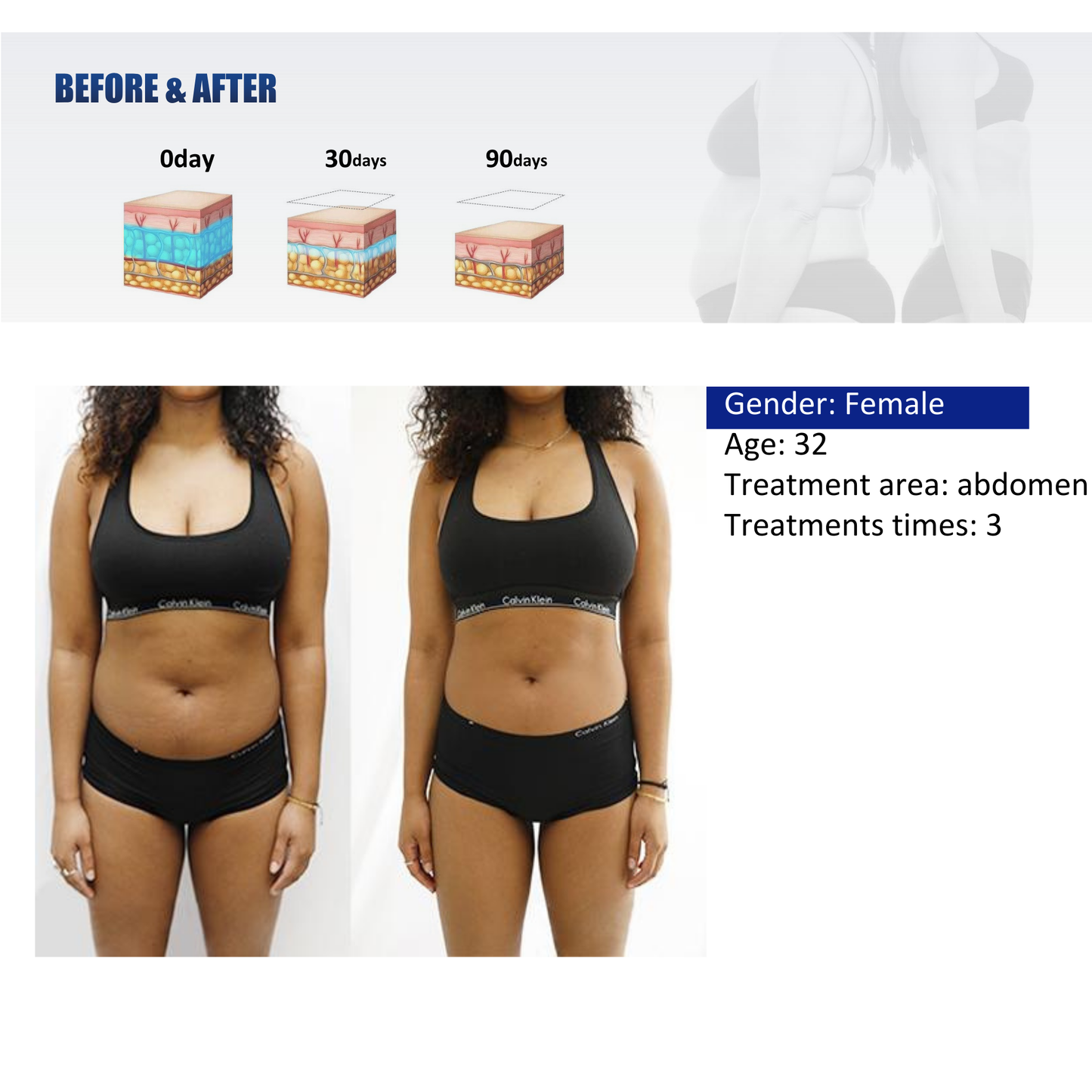 Quantus Cryosculpt 4D | Cryolipolysis with EM Sculpt