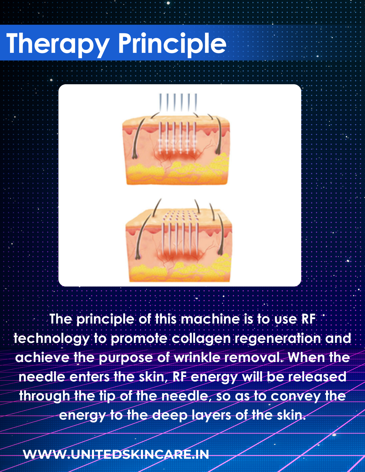 Quantus Astra MNRF | Micro Needling with Radio Frequency | 3 Handles | Invasive, Non-Invasive & Cooling Handle