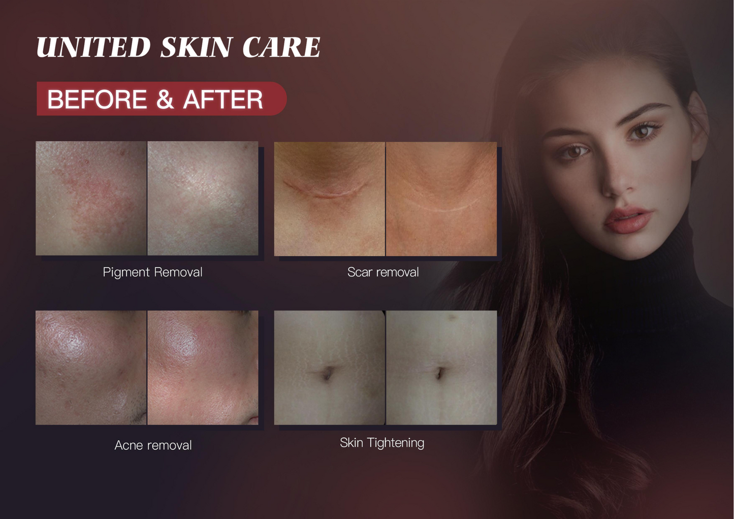 QUANTUS ULTRA BEAM CO2 | Advanced Fractional CO2 Laser Technology