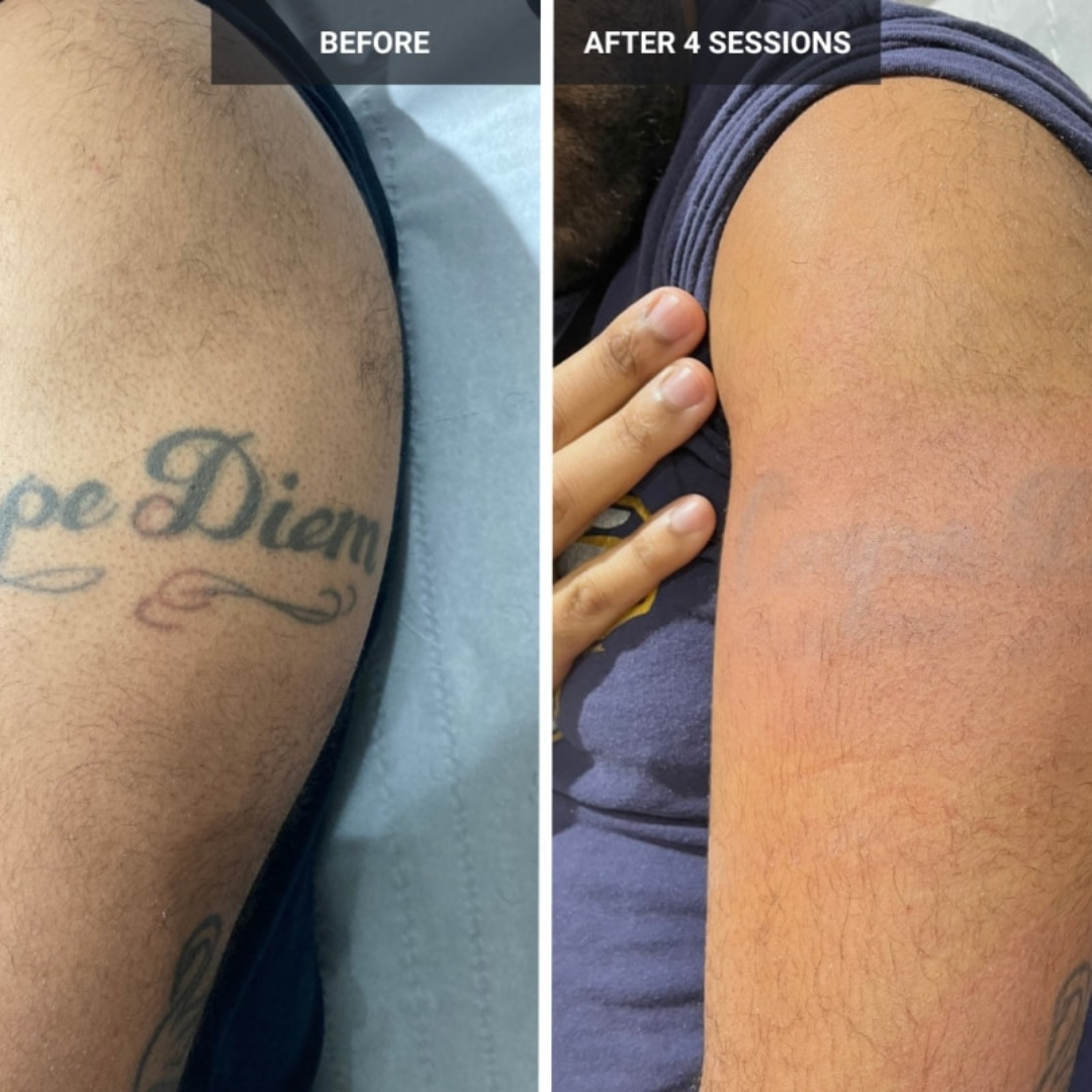 Quantus Pico Wave Pico Laser for Tattoo Removal ,Pigmentation, Melasma etc | QSwitch NdYag Laser | US FDA Approved Pico Laser System
