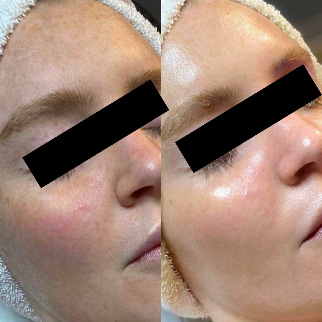 USC Oxygeno Machine 3 In One Super Facial