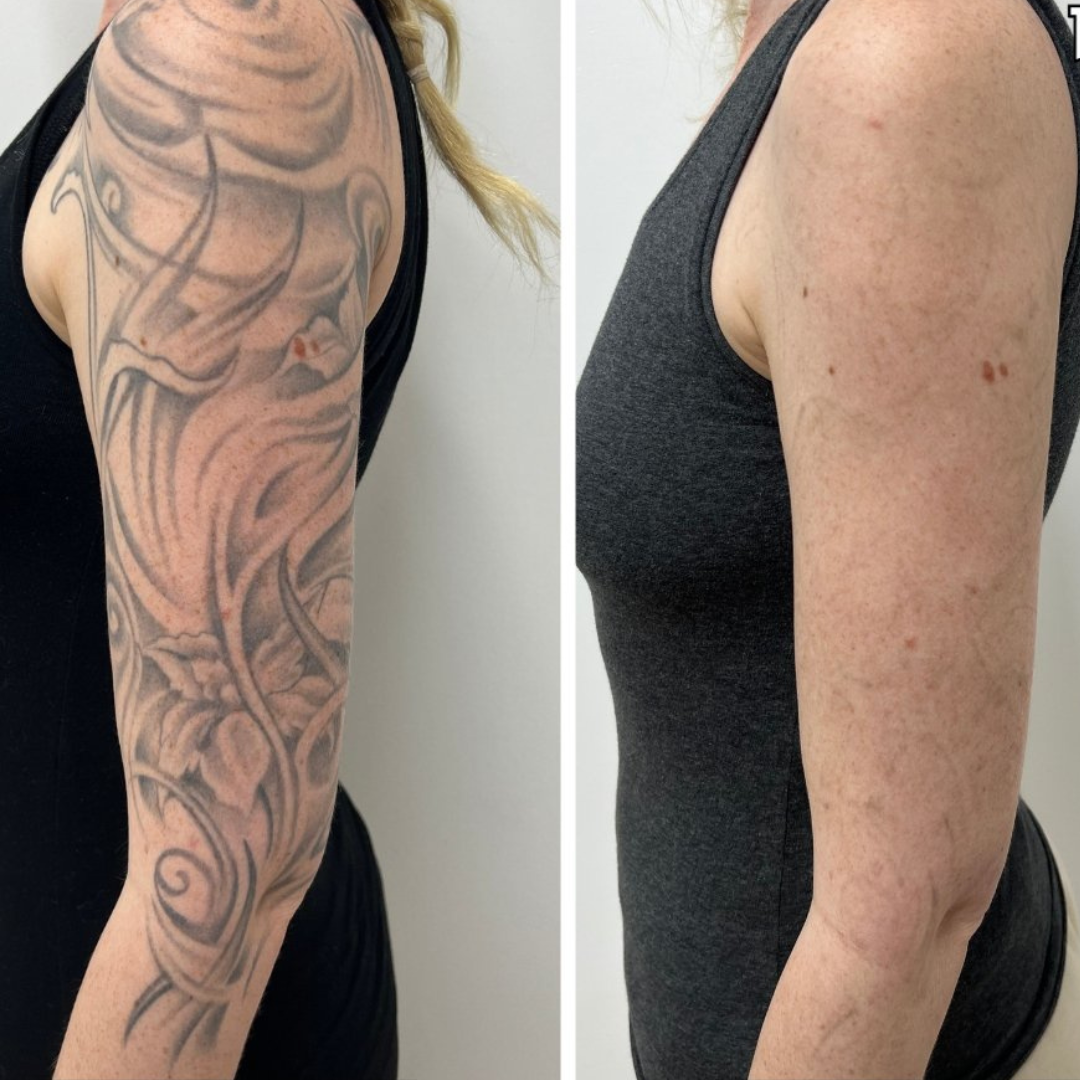 Quantus Leo Diode With Pico Laser 2 In 1 | 1200 Watt Diode Laser and Hair Removal + 1000 Watt Pico Laser