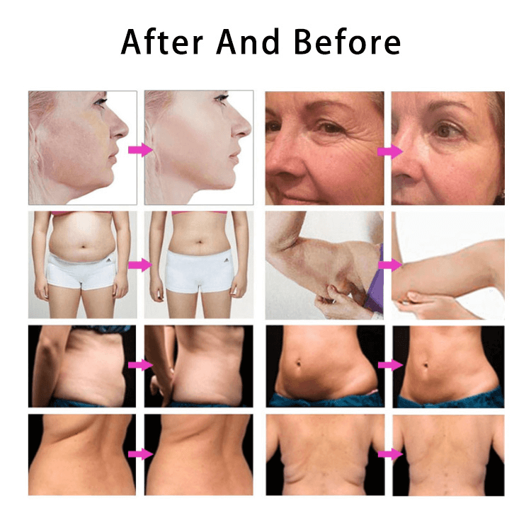 7D - Hifu Skin tightening and lifting machine