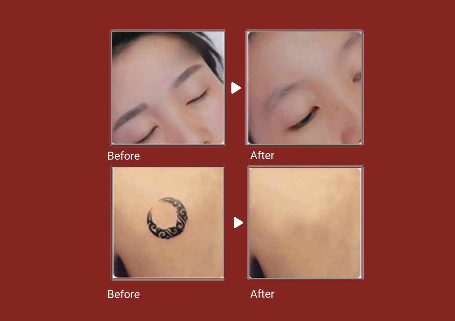 Neo Laser 2500W Diode + Nd:YAG Laser Machine | 4-Wave Diode Hair Removal + Pico Tattoo & Pigmentation | CE Approved
