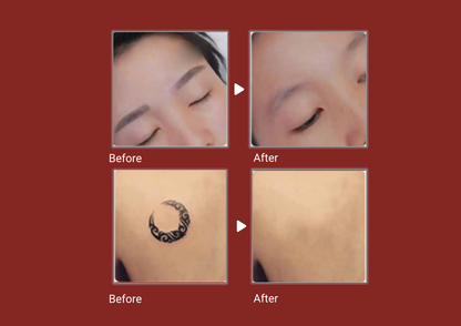 Neo Laser 2500W Diode + Nd:YAG Laser Machine | 4-Wave Diode Hair Removal + Pico Tattoo & Pigmentation | CE Approved