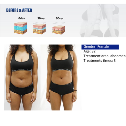 Quantus Cryosculpt 4D | Cryolipolysis with EM Sculpt