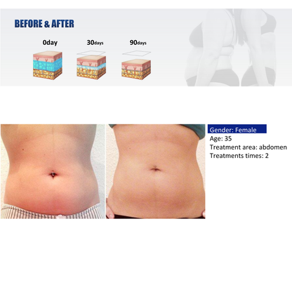 Quantus Cryosculpt 4D | Cryolipolysis with EM Sculpt