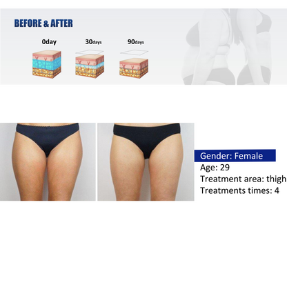 Quantus Cryosculpt 4D | Cryolipolysis with EM Sculpt