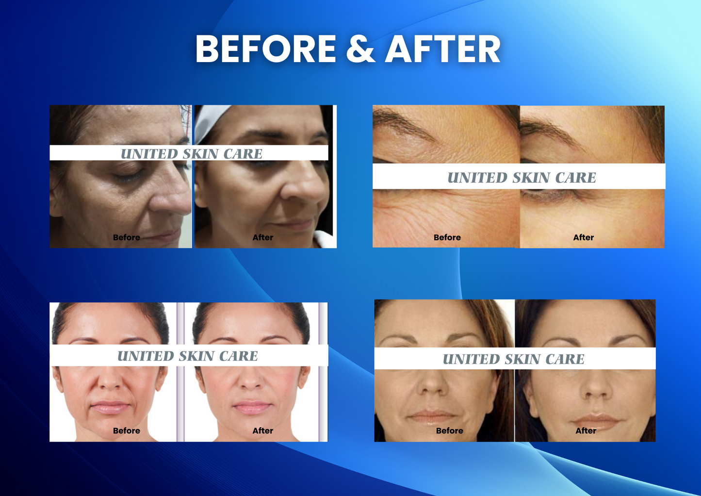 Non Ablative Rf Radio Frequency Machine + Rf Cautery | For Skin Tightening (Face And Body) 5 In 1 RF FACE LIFT MACHINE