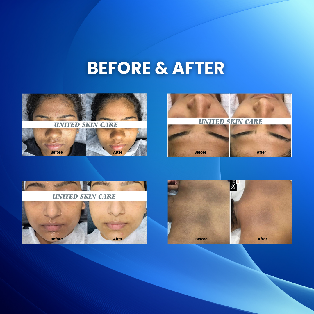HydraLuxe 5 in one |Crystal da | Diamond mda| Oxyjetspray | Hydro Facial mda | Dandruff Exfoliator | 2 year replacement warranty