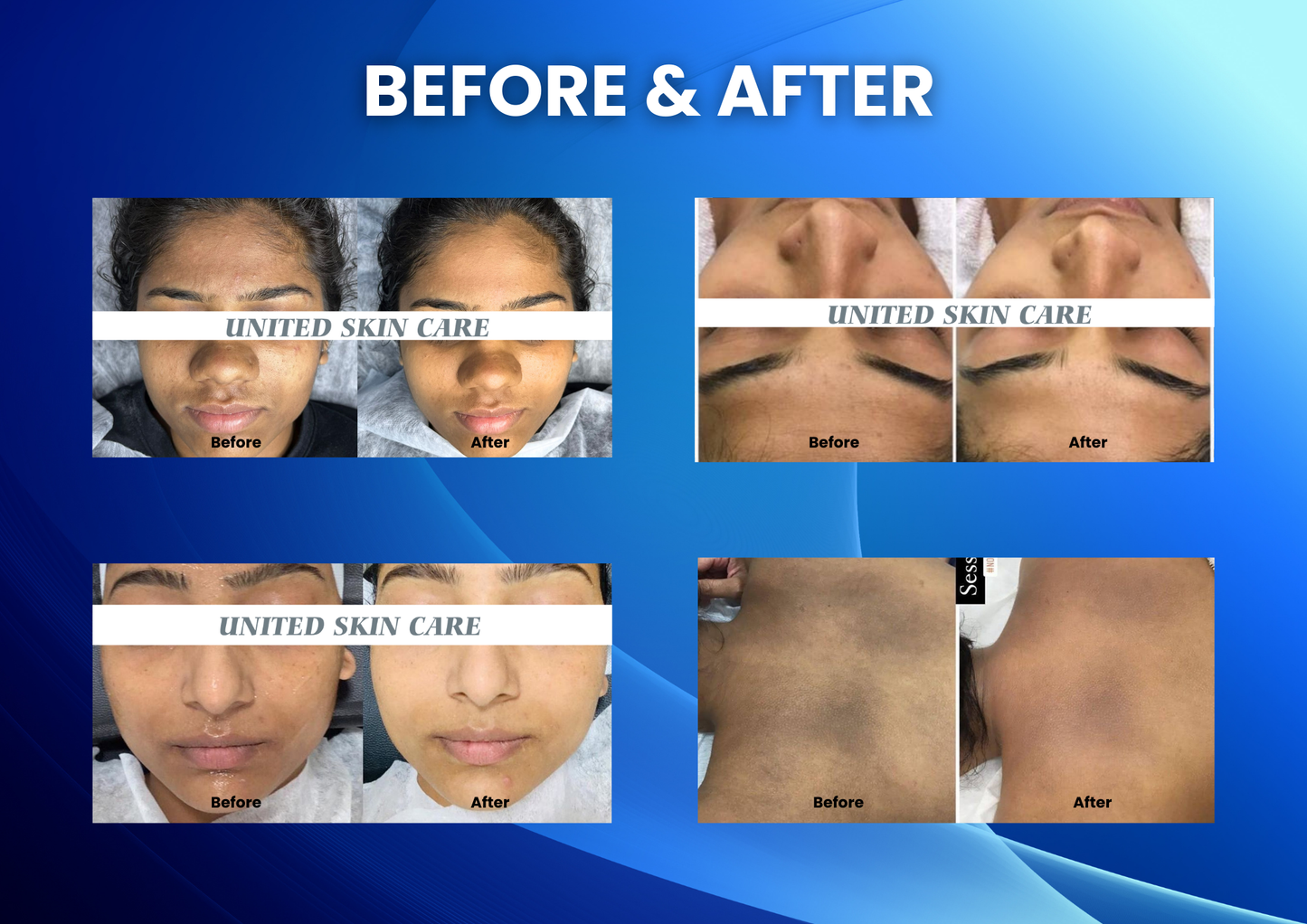Hydraluxe Hydro Facial 9 in One | Made in India | 2 Years Warranty | 9 in One Medifacial Platform
