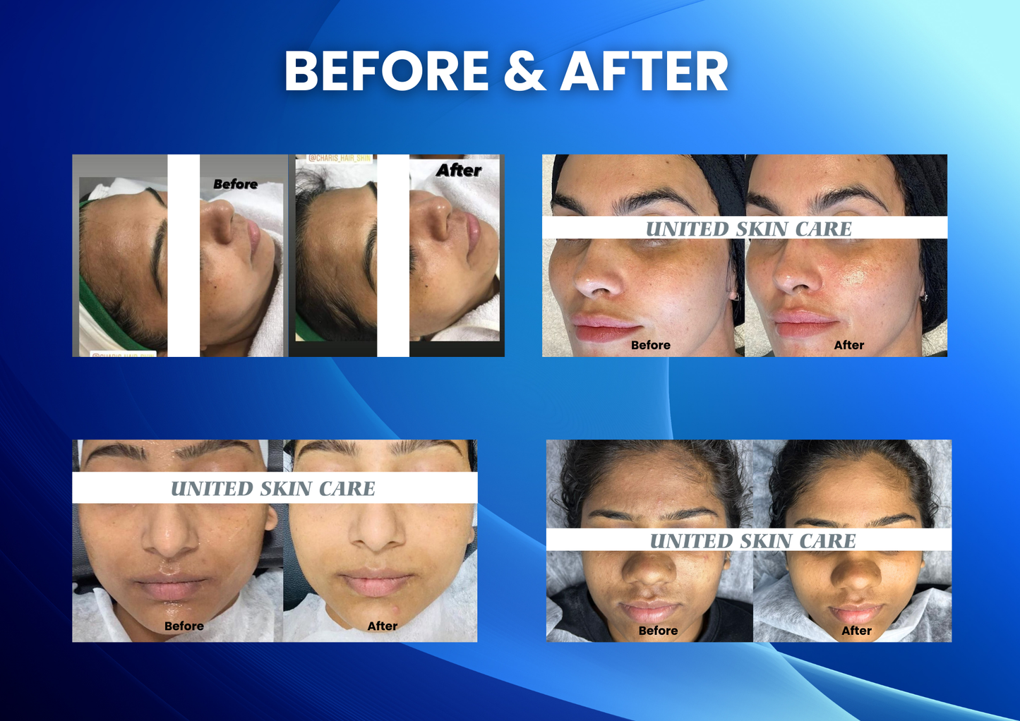 Dermaluxe Lite Hydro Facial 10 in one | Complete Medifacial Solution | 3 years replacement guarantee | Hydro Facial | Made In India