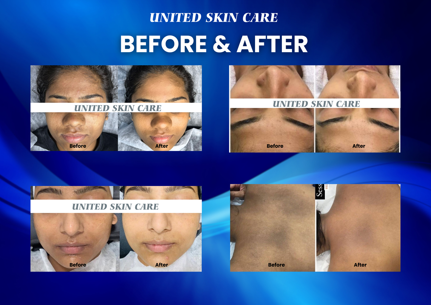 Hydraluxe 10 in One | 2 Years Warranty | Hydra Facial, Radio Frequency, Micro Dermabrasion, Oxy Jet Peel