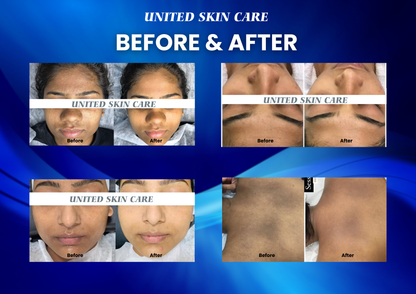 Hydraluxe 10 in One Hydra Facial | 2 Years Warranty | Hydra Facial, Radio Frequency, Micro Dermabrasion, Oxy Jet Spray, Cautery