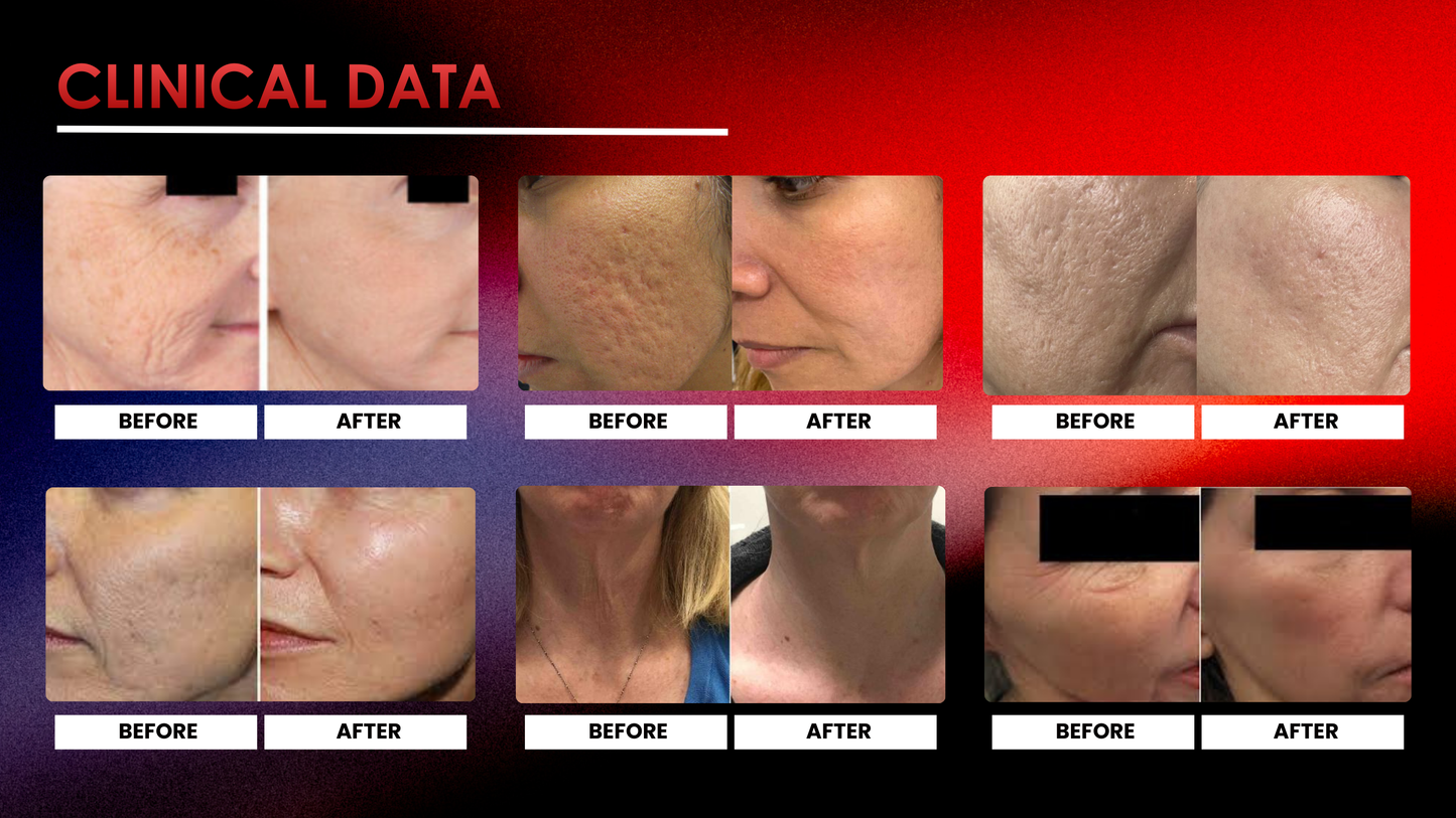 Quantus Astra MNRF | 7 mm Depth | 3.5 MHz | Invasive and Non-Invasive