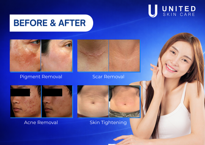 Quantus Ultra Beam CO2 Fractional Laser Machine | 60W True Power | 10600nm UltraPulse | Skin Resurfacing, Acne Scars, Pigment & Scar Removal | FDA & CE Approved | United Skin Care
