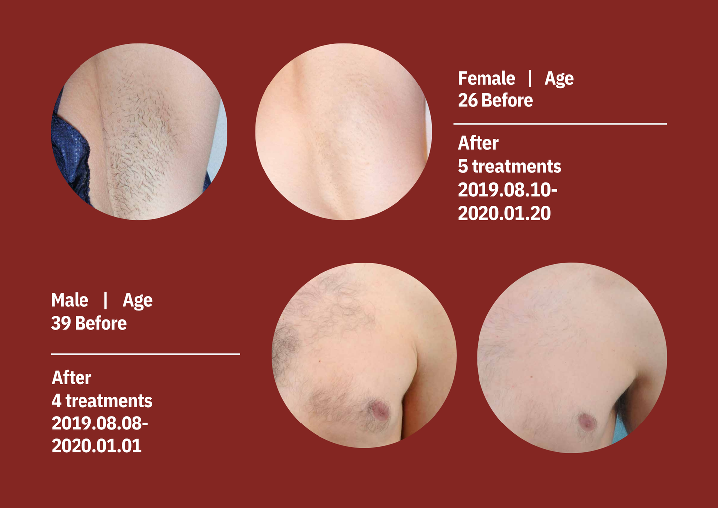 Neo Laser 2500W Diode + Nd:YAG Laser Machine | 4-Wave Diode Hair Removal + Pico Tattoo & Pigmentation | CE Approved