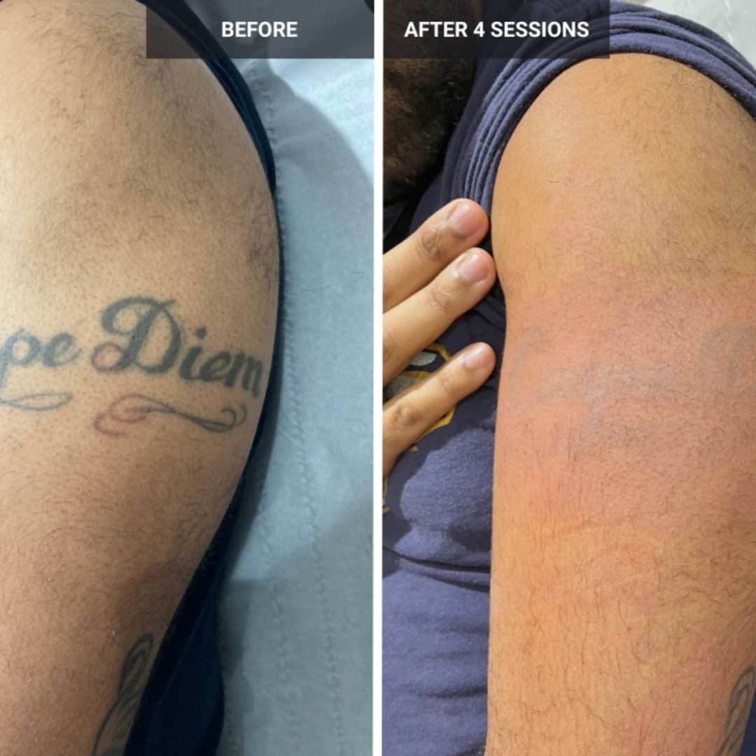 Quantus Leo  Diode With Pico Laser 2 In 1 | 1200 Watt Diode Laser and Hair Removal + 1000 Watt Pico Laser