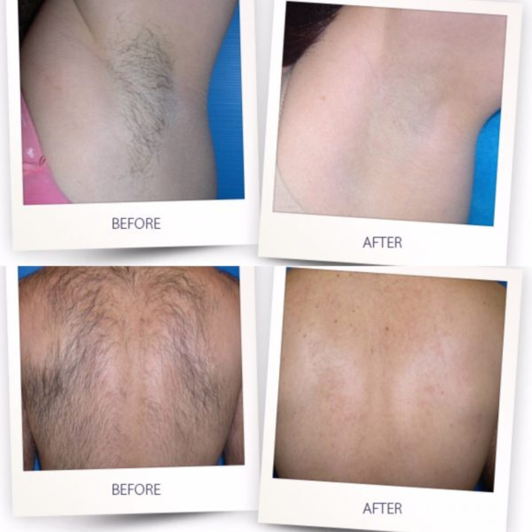 Quantus Leo  Diode With Pico Laser 2 In 1 | 1200 Watt Diode Laser and Hair Removal + 1000 Watt Pico Laser