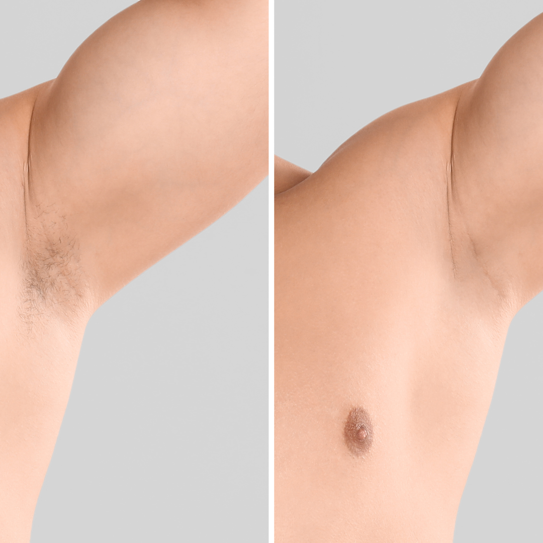 Quantus Leo  Diode With Pico Laser 2 In 1 | 1200 Watt Diode Laser and Hair Removal + 1000 Watt Pico Laser