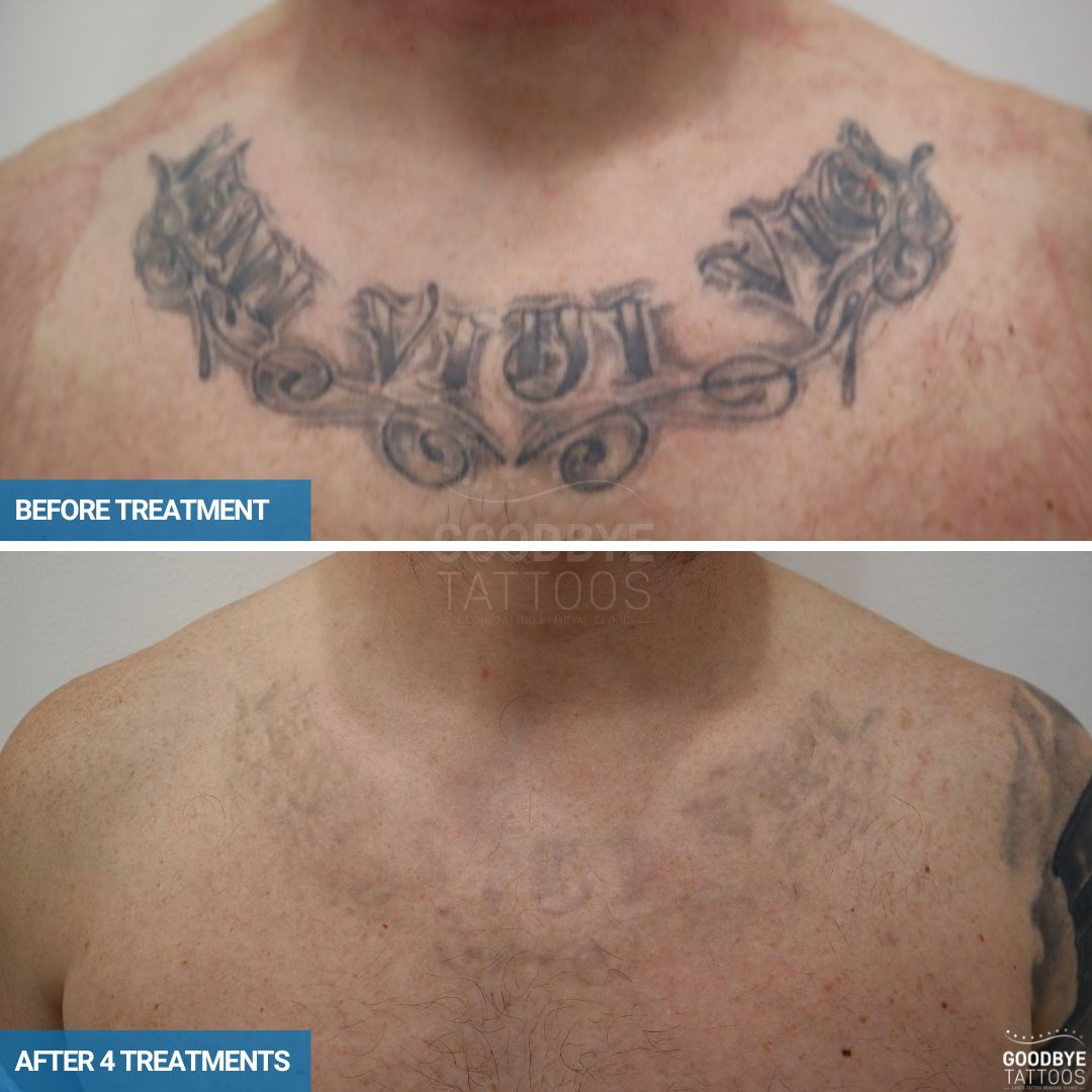 Quantus Pico Wave Pico Laser for Tattoo Removal ,Pigmentation, Melasma etc | QSwitch NdYag Laser | US FDA Approved Pico Laser System