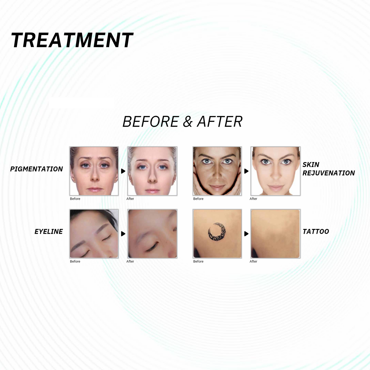 Quantus Pico Wave Pico Laser for Tattoo Removal ,Pigmentation, Melasma etc | QSwitch NdYag Laser | US FDA Approved Pico Laser System
